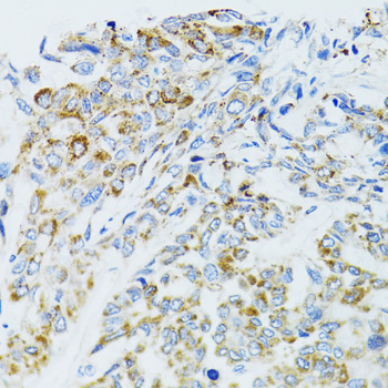 Immunohistochemistry of paraffin-embedded Human liver cancer using EGFR Polyclonal Antibody at dilution of  1:100 (40x lens).