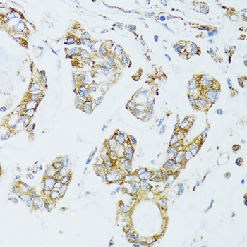 Immunohistochemistry of paraffin-embedded Human gastric cancer using EGFR Polyclonal Antibody at dilution of  1:100 (40x lens).