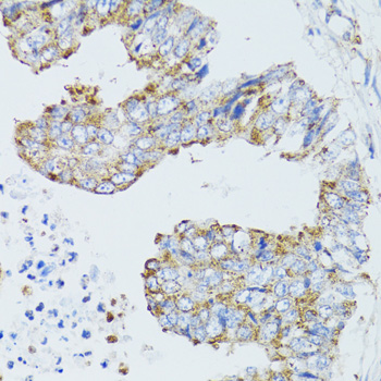 Immunohistochemistry of paraffin-embedded Human rectal cancer using EGFR Polyclonal Antibody at dilution of  1:100 (40x lens).