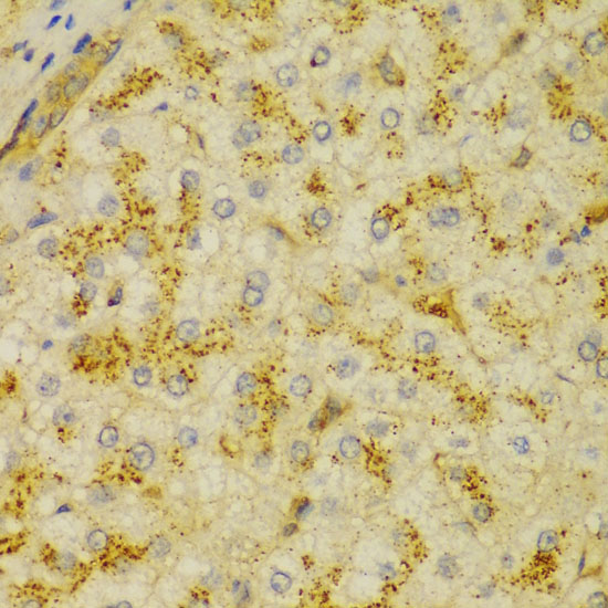 Immunohistochemistry of paraffin-embedded Human liver cancer using ACTN1 Polyclonal Antibody at dilution of  1:100 (40x lens).