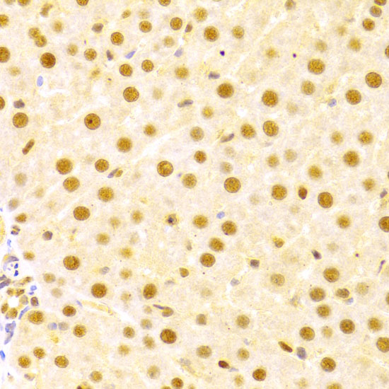 Immunohistochemistry of paraffin-embedded Human liver damage using CDC25A Polyclonal Antibody at dilution of  1:100 (40x lens).