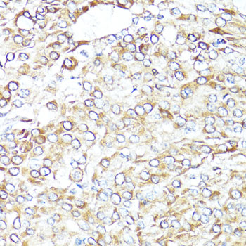 Immunohistochemistry of paraffin-embedded Human lung cancer using BAX Polyclonal Antibody at dilution of  1:100 (40x lens).