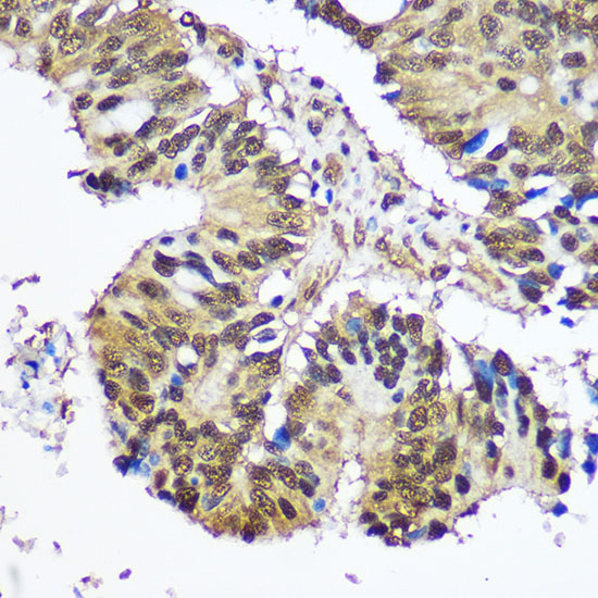 Immunohistochemistry of paraffin-embedded Human colon carcinoma using UBA1 Polyclonal Antibody at dilution of  1:100 (40x lens).