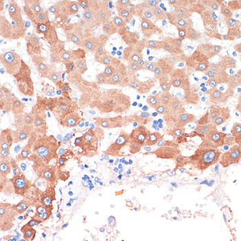 Immunohistochemistry of paraffin-embedded Human liver cancer using CHAT Polyclonal Antibody at dilution of  1:200 (40x lens).