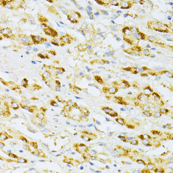 Immunohistochemistry of paraffin-embedded Human liver cancer using FLT3 Polyclonal Antibody at dilution of  1:100 (40x lens).