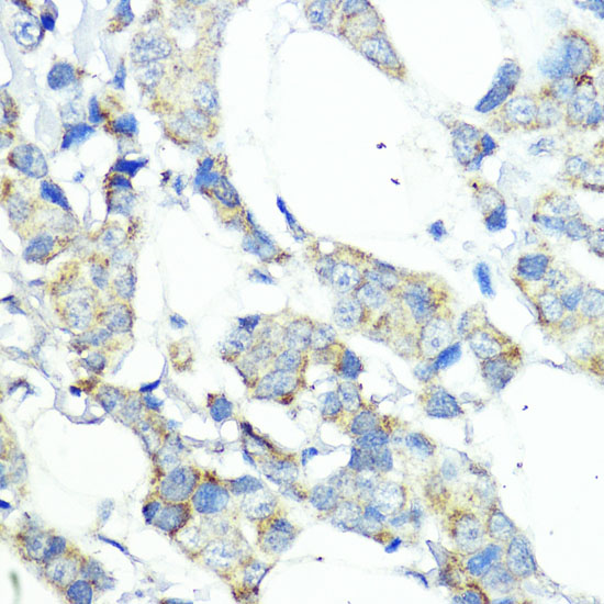 Immunohistochemistry of paraffin-embedded Human mammary cancer using NOD1 Polyclonal Antibody at dilution of  1:100 (40x lens).