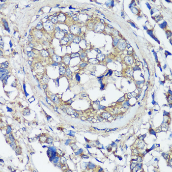 Immunohistochemistry of paraffin-embedded Human breast cancer using VAMP2 Polyclonal Antibody at dilution of  1:100 (40x lens).