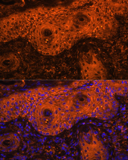 Immunofluorescence analysis of Human skin cancer using TYR Polyclonal Antibody at dilution of  1:100. Blue: DAPI for nuclear staining.