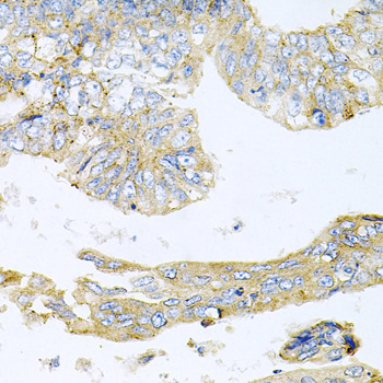 Immunohistochemistry of paraffin-embedded Human colon carcinoma using HDAC3 Polyclonal Antibody at dilution of  1:100 (40x lens).