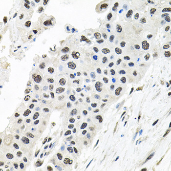 Immunohistochemistry of paraffin-embedded Human lung cancer using CDCA8 Polyclonal Antibody at dilution of  1:100 (40x lens).