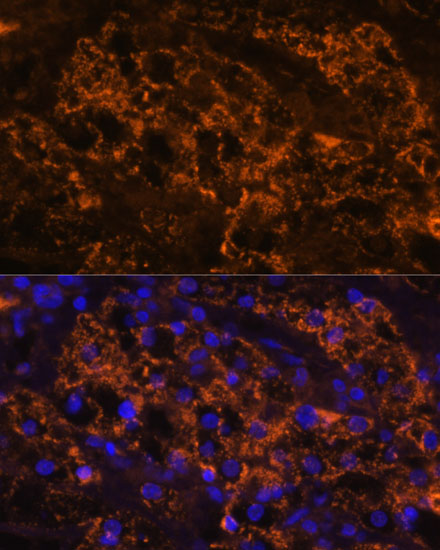 Immunofluorescence analysis of Human kidney cancer using SLC7A9 Polyclonal Antibody at dilution of  1:100. Blue: DAPI for nuclear staining.