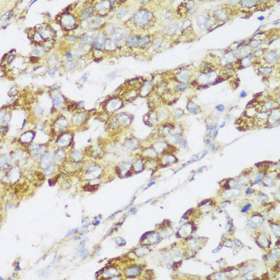 Immunohistochemistry of paraffin-embedded Human liver cancer using ECH1 Polyclonal Antibody at dilution of  1:150 (40x lens).