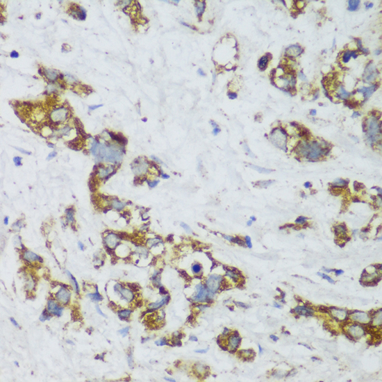 Immunohistochemistry of paraffin-embedded Human gastric cancer using ECH1 Polyclonal Antibody at dilution of  1:150 (40x lens).