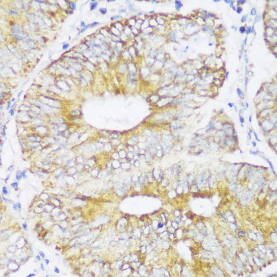 Immunohistochemistry of paraffin-embedded Human colon carcinoma using ECH1 Polyclonal Antibody at dilution of  1:150 (40x lens).