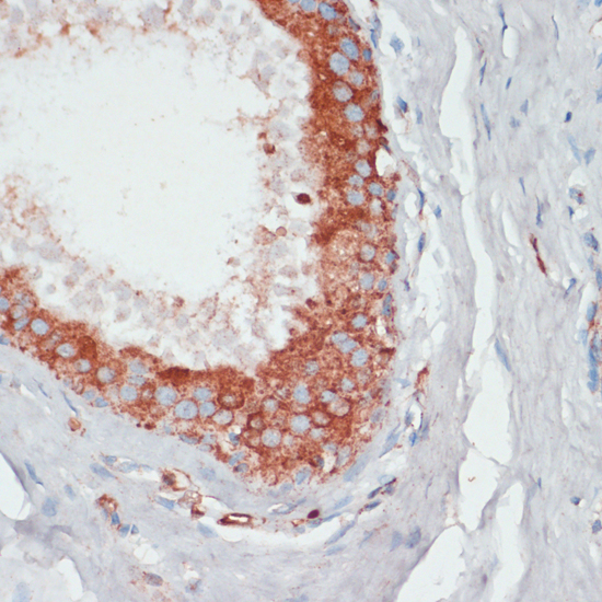 Immunohistochemistry of paraffin-embedded Human mammary cancer using PGK2 Polyclonal Antibody at dilution of  1:100 (40x lens).
