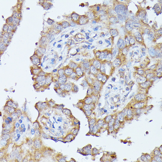 Immunohistochemistry of paraffin-embedded Human lung cancer using HAL Polyclonal Antibody at dilution of  1:100 (40x lens).