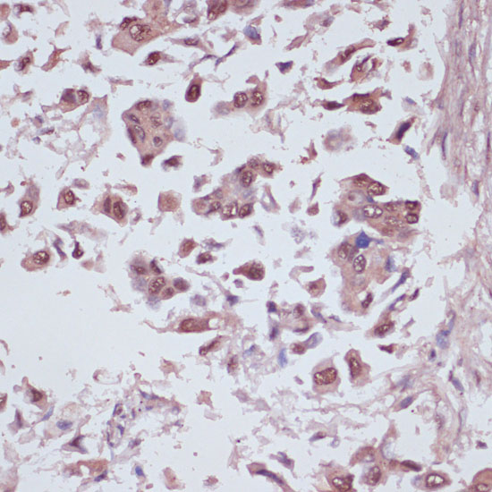 Immunohistochemistry of paraffin-embedded Human lung cancer using U2AF1 Polyclonal Antibody at dilution of  1:100 (40x lens).