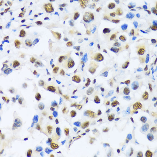 Immunohistochemistry of paraffin-embedded Human lung cancer using OTP Polyclonal Antibody at dilution of  1:100 (40x lens).