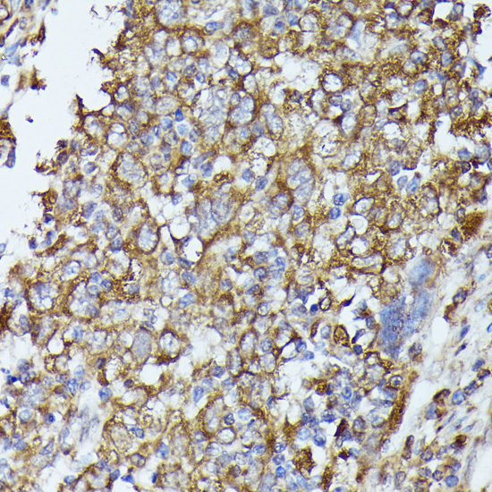 Immunohistochemistry of paraffin-embedded Human esophageal cancer using TBCB Polyclonal Antibody at dilution of  1:100 (40x lens).