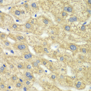 Immunohistochemistry of paraffin-embedded Human liver damage using DLD Polyclonal Antibody at dilution of  1:100 (40x lens).