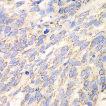 Immunohistochemistry of paraffin-embedded Human esophageal cancer using DLD Polyclonal Antibody at dilution of  1:100 (40x lens).