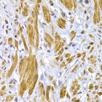 Immunohistochemistry of paraffin-embedded Human gastric cancer using Desmoplakin Polyclonal Antibody at dilution of  1:100 (40x lens).