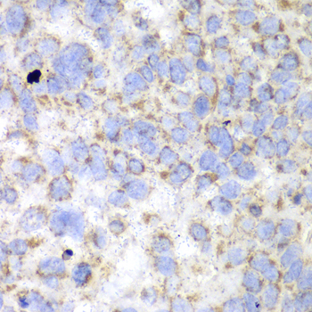 Immunohistochemistry of paraffin-embedded Human esophageal cancer using HADHA Polyclonal Antibody at dilution of  1:100 (40x lens).