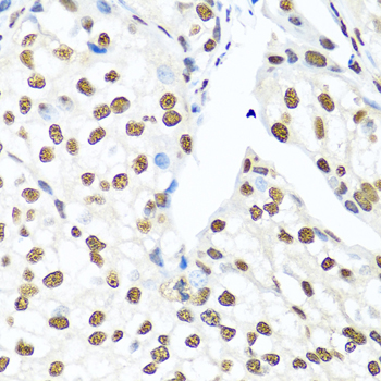 Immunohistochemistry of paraffin-embedded Human prostate cancer using XRCC5 Polyclonal Antibody at dilution of  1:100 (40x lens).