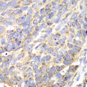 Immunohistochemistry of paraffin-embedded Human esophageal cancer using ACY1 Polyclonal Antibody at dilution of  1:100 (40x lens).