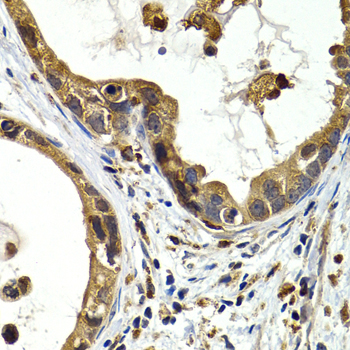 Immunohistochemistry of paraffin-embedded Human gastric cancer using CTSS Polyclonal Antibody at dilution of  1:200 (40x lens).