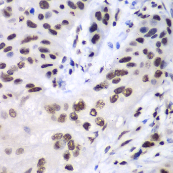 Immunohistochemistry of paraffin-embedded Human esophageal cancer using LIG3 Polyclonal Antibody at dilution of  1:100 (40x lens).