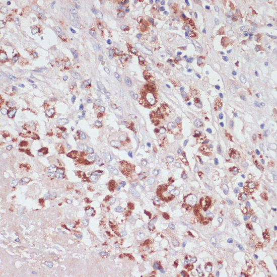 Immunohistochemistry of paraffin-embedded Human liver cancer using LYZ Polyclonal Antibody at dilution of  1:100 (40x lens).