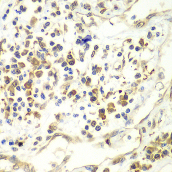 Immunohistochemistry of paraffin-embedded Human liver cancer using UPF1 Polyclonal Antibody at dilution of  1:100 (40x lens).