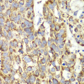 Immunohistochemistry of paraffin-embedded Human lung cancer using UGDH Polyclonal Antibody at dilution of  1:100 (40x lens).