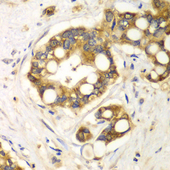 Immunohistochemistry of paraffin-embedded Human liver cancer using RPH3A Polyclonal Antibody at dilution of  1:100 (40x lens).