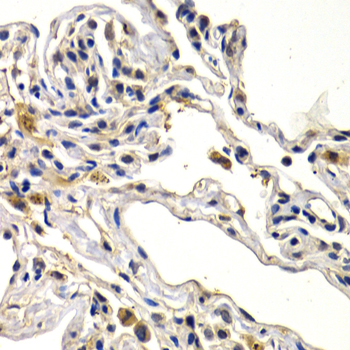 Immunohistochemistry of paraffin-embedded Human lung cancer using WNT3A Polyclonal Antibody at dilution of  1:200 (40x lens).