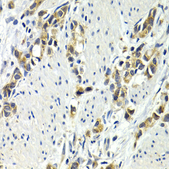 Immunohistochemistry of paraffin-embedded Human gastric cancer using WNT3A Polyclonal Antibody at dilution of  1:200 (40x lens).