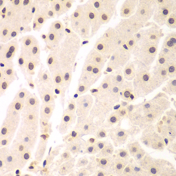 Immunohistochemistry of paraffin-embedded Human liver cancer using UHRF2 Polyclonal Antibody at dilution of  1:200 (40x lens).