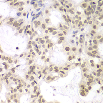 Immunohistochemistry of paraffin-embedded Human oophoroma using UHRF2 Polyclonal Antibody at dilution of  1:200 (40x lens).