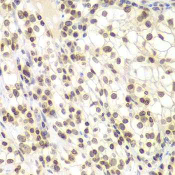 Immunohistochemistry of paraffin-embedded Human kidney cancer using UHRF2 Polyclonal Antibody at dilution of  1:200 (40x lens).