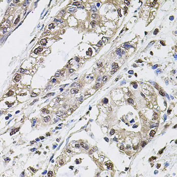Immunohistochemistry of paraffin-embedded Human gastric cancer using CA9 Polyclonal Antibody at dilution of  1:100 (40x lens).