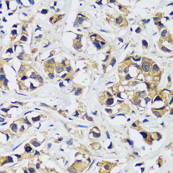 Immunohistochemistry of paraffin-embedded Human breast cancer using CAMLG Polyclonal Antibody at dilution of  1:100 (40x lens).