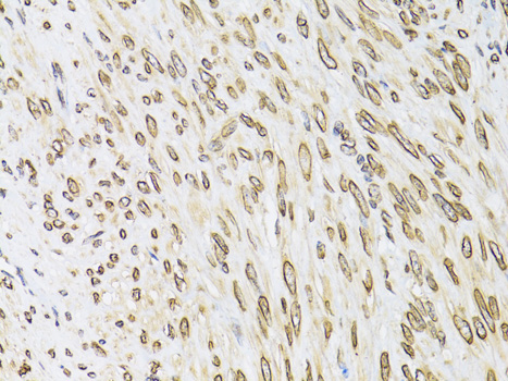 Immunohistochemistry of paraffin-embedded Human uterine cancer using EMD Polyclonal Antibody at dilution of  1:100 (40x lens).