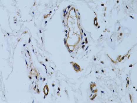 Immunohistochemistry of paraffin-embedded Human colon carcinoma using MCAM Polyclonal Antibody at dilution of  1:100 (40x lens).