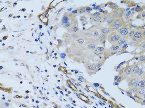 Immunohistochemistry of paraffin-embedded Human breast cancer using MCAM Polyclonal Antibody at dilution of  1:100 (40x lens).