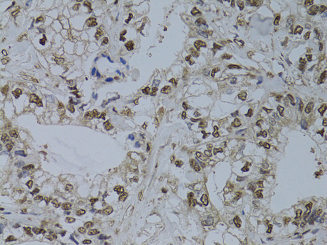 Immunohistochemistry of paraffin-embedded Human gastric cancer using HUS1 Polyclonal Antibody at dilution of  1:100 (40x lens).