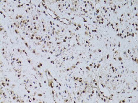 Immunohistochemistry of paraffin-embedded Human uterine cancer using HUS1 Polyclonal Antibody at dilution of  1:100 (40x lens).