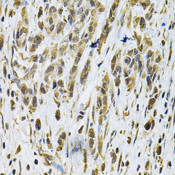 Immunohistochemistry of paraffin-embedded Human gastric cancer using RhoA Polyclonal Antibody at dilution of  1:100 (40x lens).