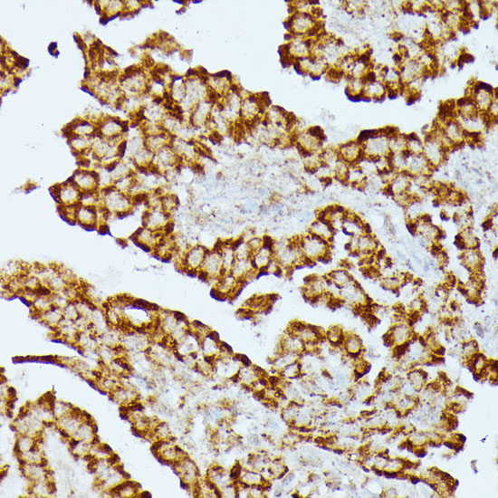 Immunohistochemistry of paraffin-embedded Human thyroid cancer using HMGCS2 Polyclonal Antibody at dilution of  1:100 (40x lens).