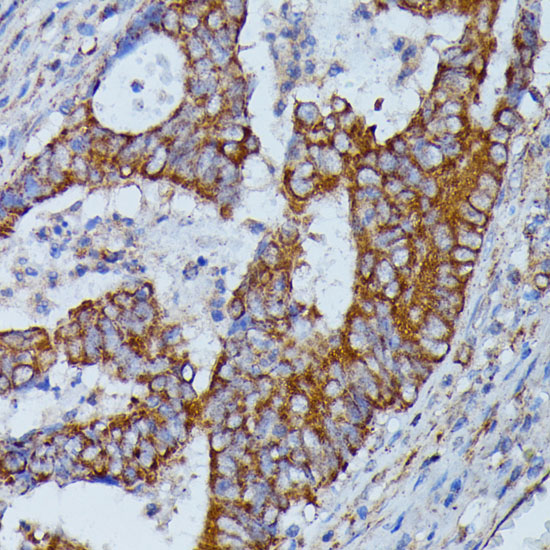 Immunohistochemistry of paraffin-embedded Human colon carcinoma using HMGCS2 Polyclonal Antibody at dilution of  1:100 (40x lens).